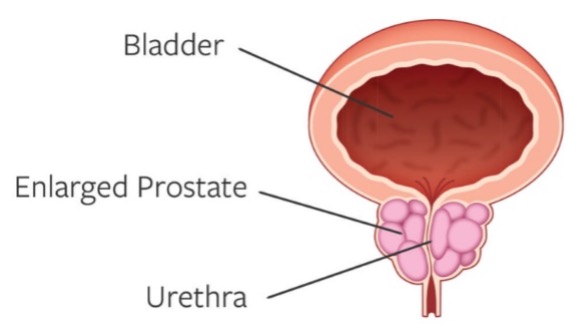 Illustration of Enlarged Prostate